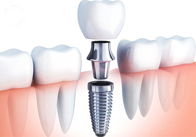 Dental / Orthopedic Implants